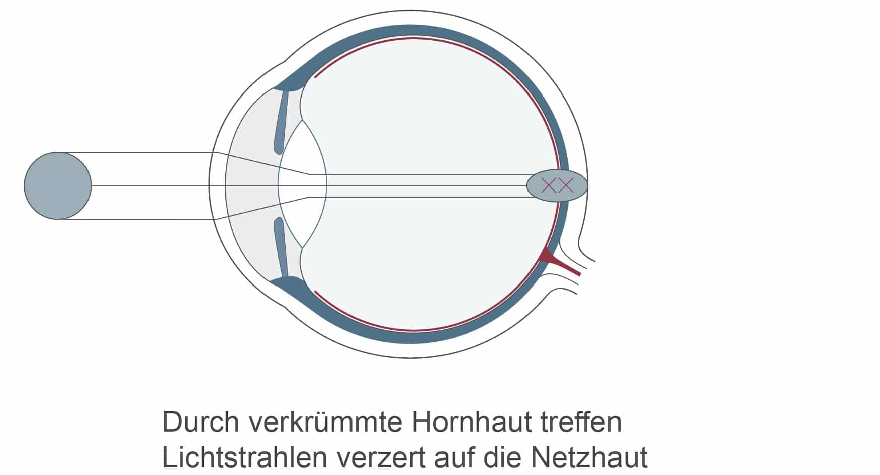 Hornhautverkrümmung: Unterschiedlich starke Wölbungen